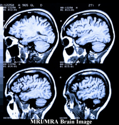 MRI/MRA Brain Image - Spivey Law Firm, Personal Injury Attorneys, P.A.