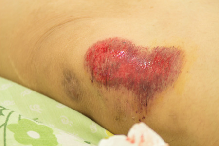 When is Road Rash in a Motorcycle Accident Dangerous - Spivey Law