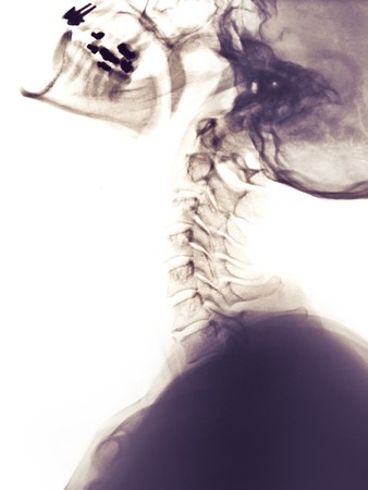 Cervical Spine Injuries May Result in Compensation; Spivey Law Firm Personal Injury Attorney;s, P.A.